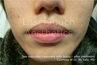 jaw_reduction_after_2